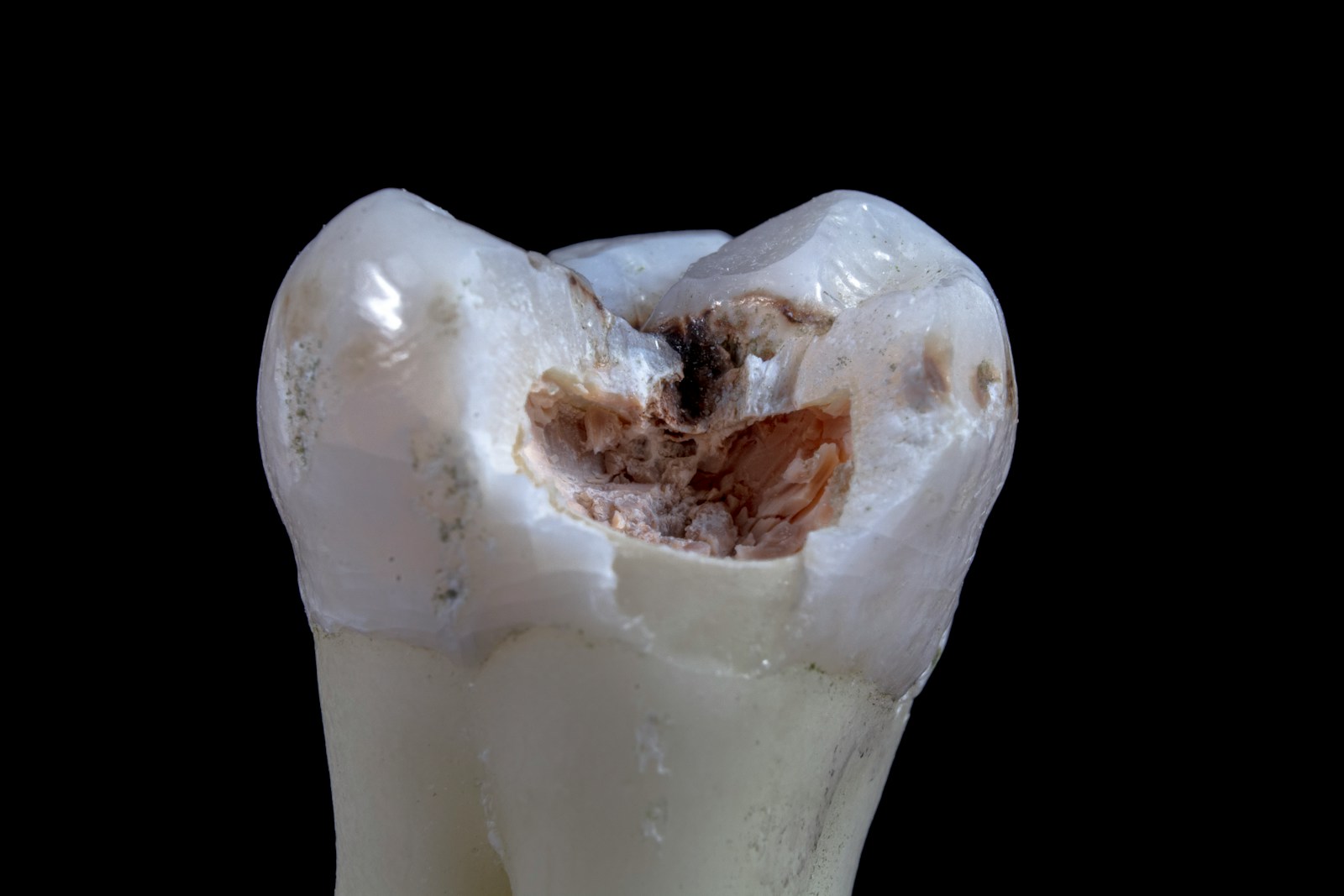 3 Key Preventive Tools Dentists Use To Reduce Cavity Risk a white substance in a glass