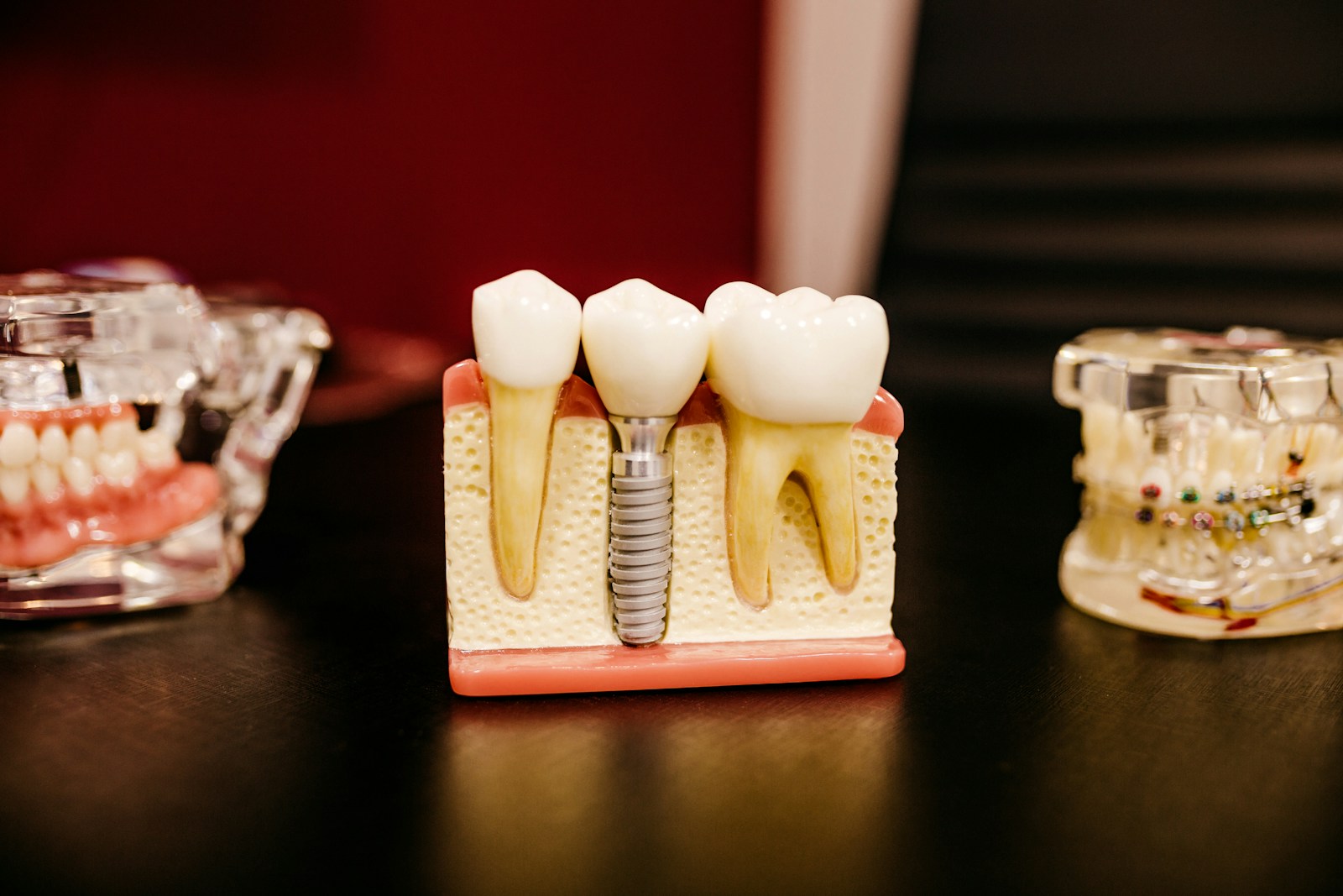 5 Benefits Of Choosing Implants Over Traditional Restorations white and yellow wooden condiment shakers